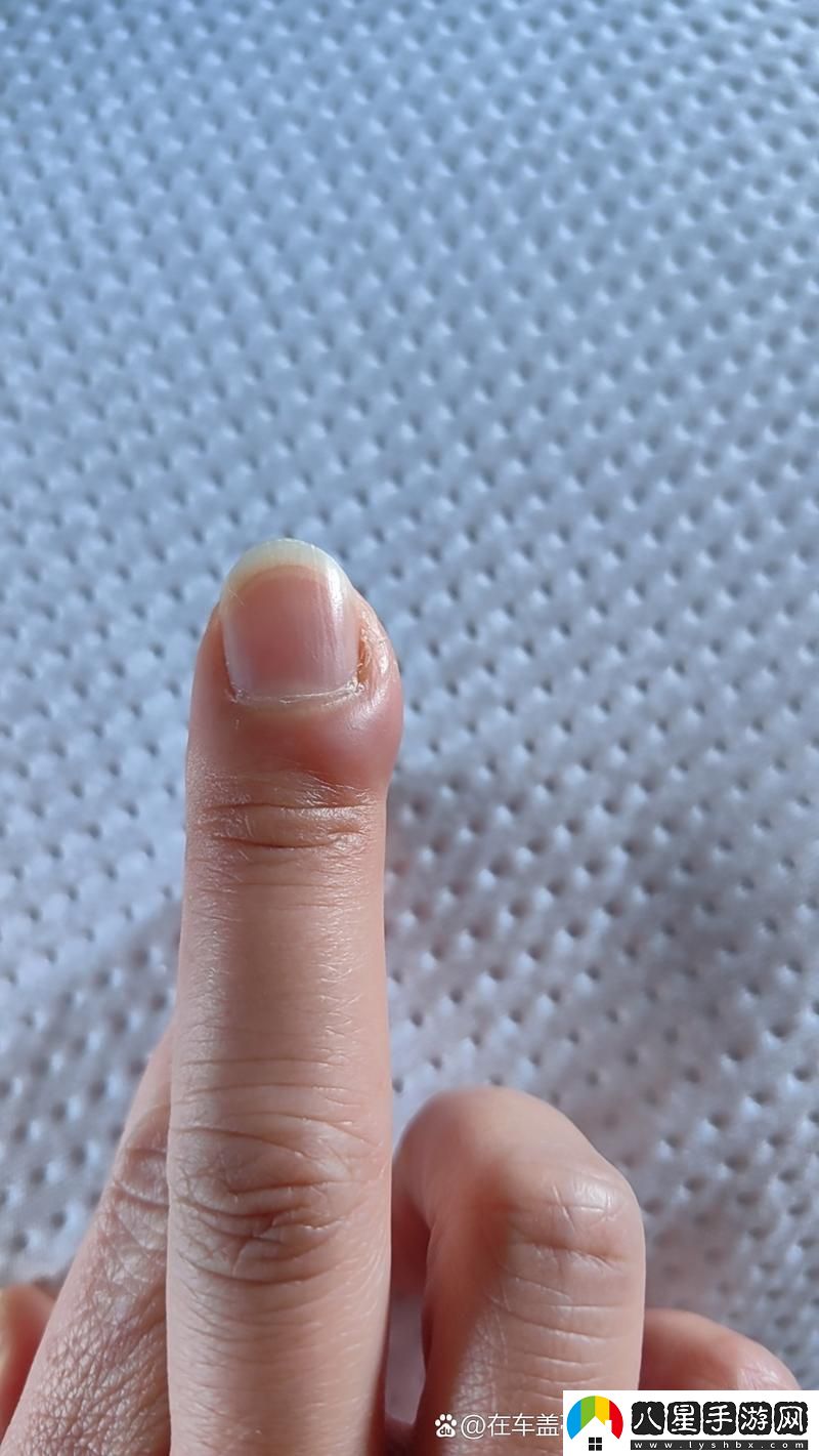 粗大的蘑菇頭刮得又紅又腫怎么辦上線(xiàn)